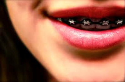 How to Floss With Braces