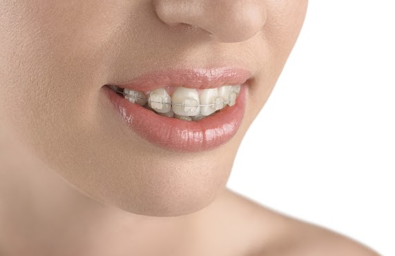 The pros and cons of clear braces