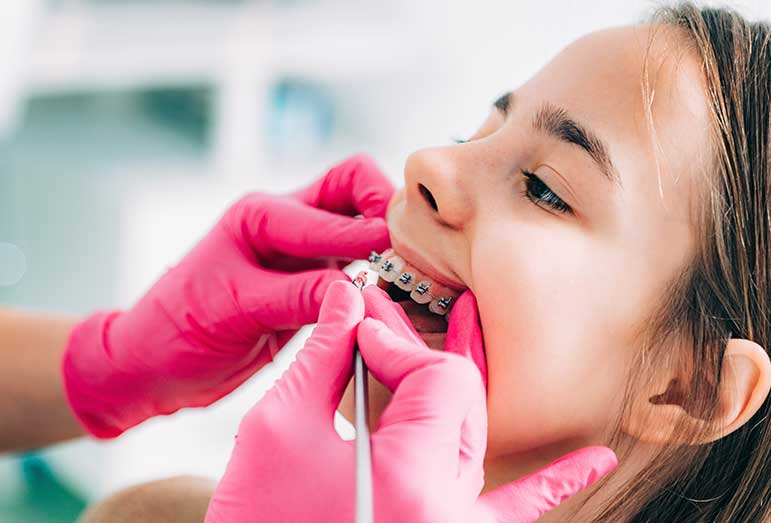 get braces?