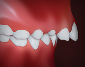 Upper Front Teeth Protrusion