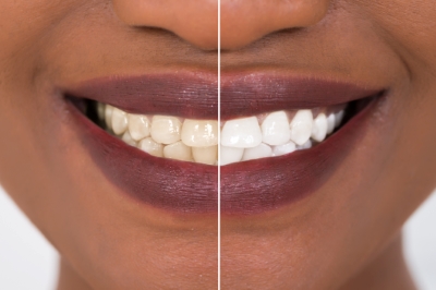 Teeth Whitening: Myths and Facts