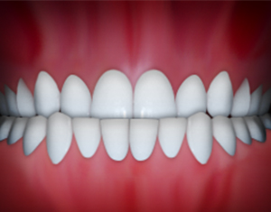 Underbite