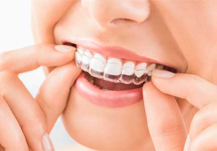 Invisalign