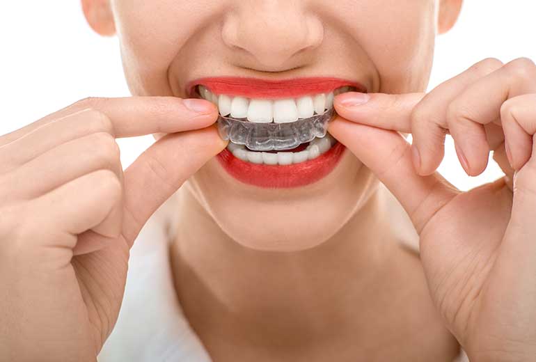 CLEAR ALIGNERS?