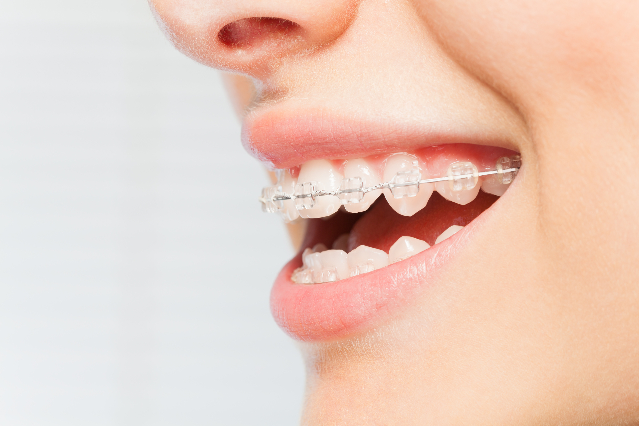 Choosing Ceramic Braces: A Guide for Adults Seeking Discreet Orthodontics