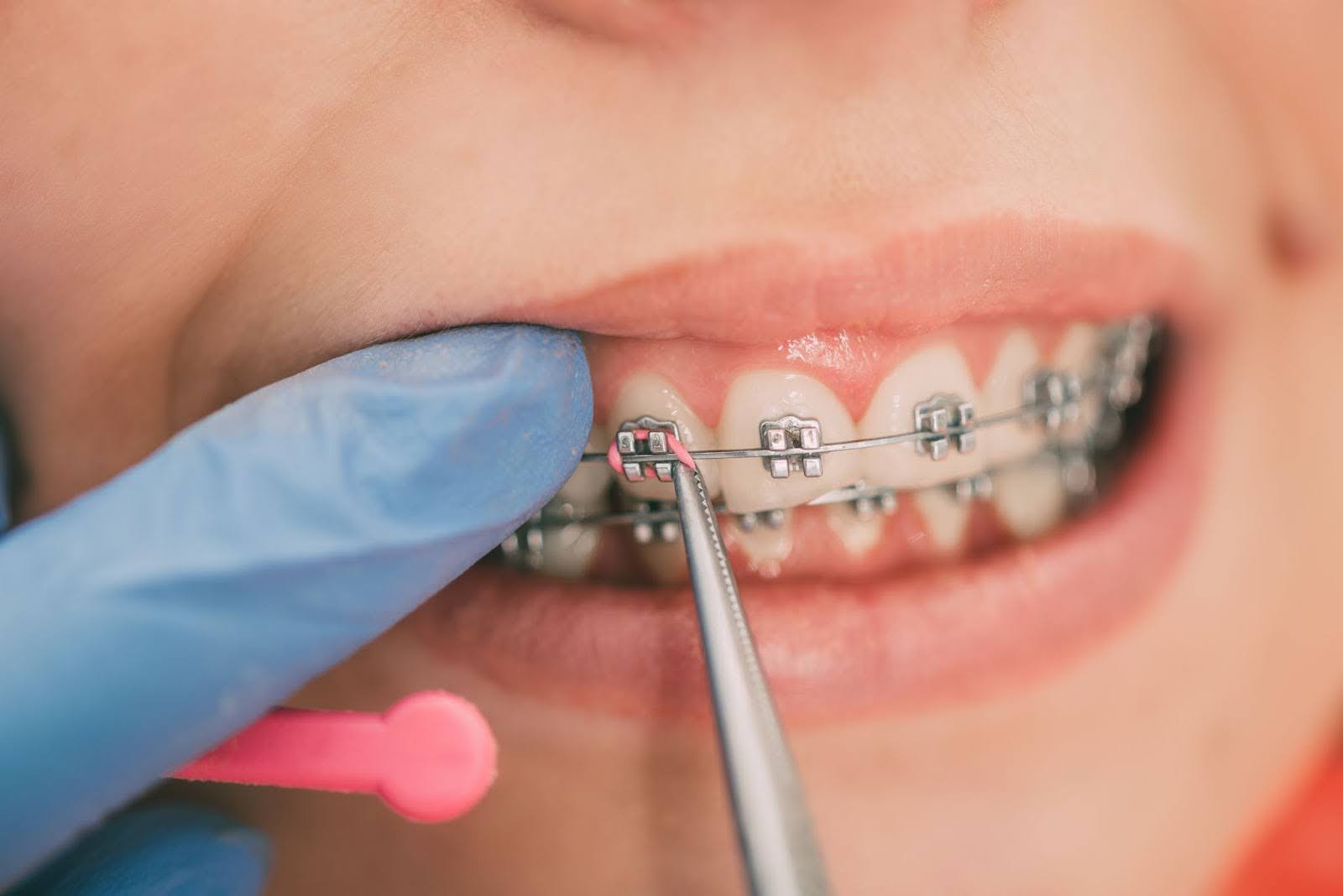 Secrets to a Smooth Transition: From Consultations to Your New Braces